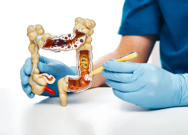 Phương pháp điều trị polyp đại trực tràng? 